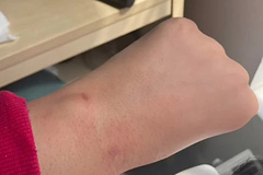 Девушка попробовала безболезненную эпиляцию и осталась с ожогами на теле: Явления: Ценности: Lenta.ru