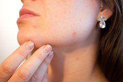 Перечислены способы быстро избавиться от прыща: Явления: Ценности: Lenta.ru0
