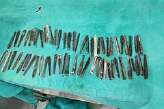 Врачи извлекли 63 черенка от ложек из желудка мужчины: Аномалии: Из жизни: Lenta.ru0